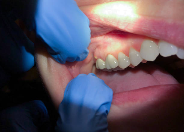 Best Emergency Tooth Extraction in Schofield Barracks, HI